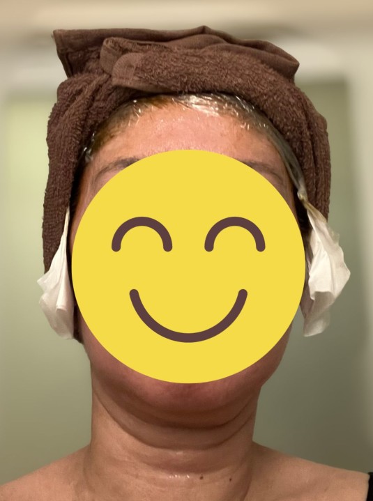 手袋をした手でヘナペーストを前髪に直接塗布した後、頭部全面にラップをまき、さらにタオルで覆った写真。もみあげ部分にティッシュを付けてヘナペーストの乾燥を抑えている。