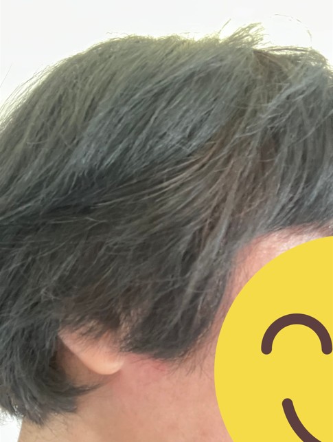 ヘナ染め後の耳周り。くせ毛がましになっている。