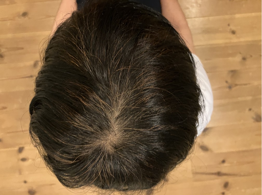 ヘナ染め３か月後の頭頂部の写真（照明（電球色））